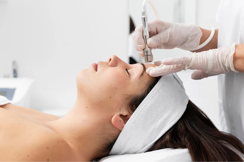 „Microneedling Behandlung bei Elsa Cosmetic Hannover zur Hauterneuerung“